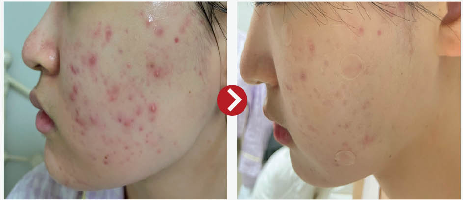 acne 2.png__PID:0c35d697-b990-42a5-9864-353097ea101a