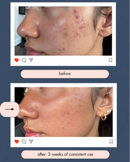 Saranghae Acne 5-Step Skincare Routine