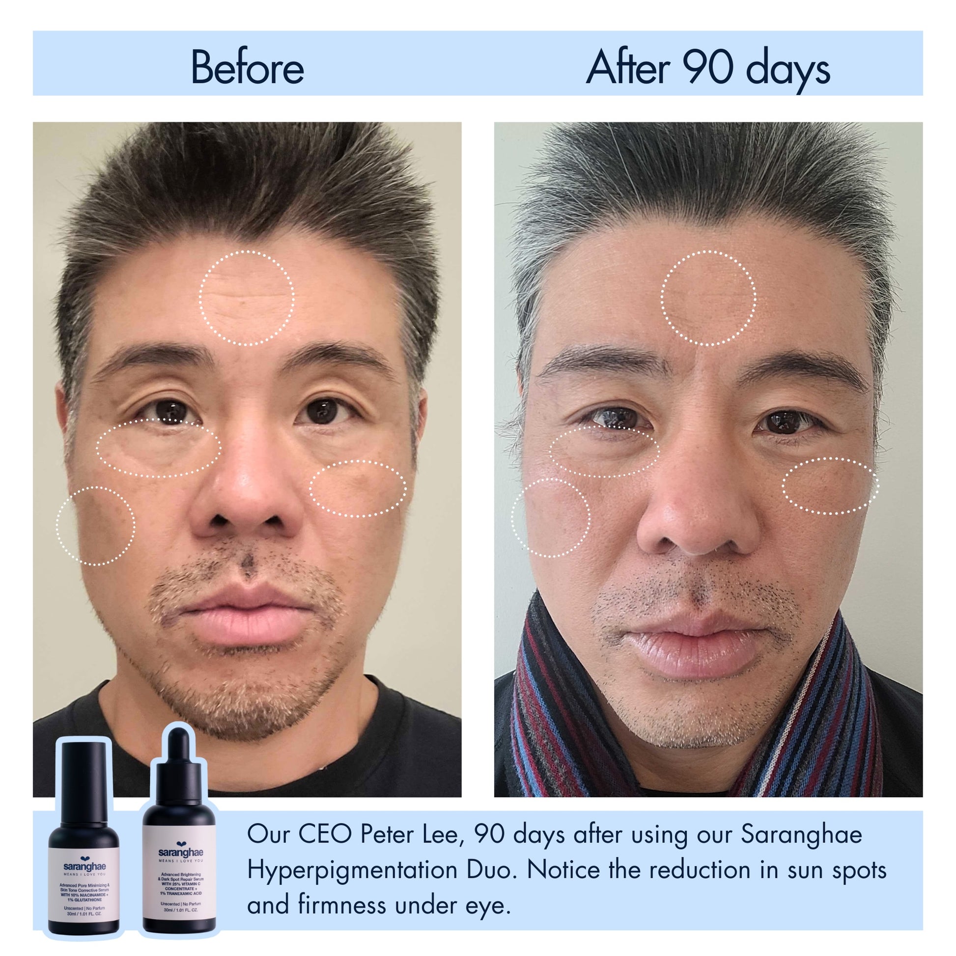 peter before and after saranghae hyperpigmentatio duo.jpg__PID:327b2c88-f905-4e2a-8eac-d41e3a4af54b
