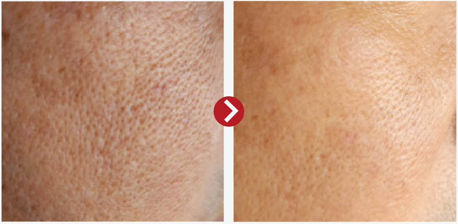 Advanced Pore Minimizing & Skin Tone Corrective Serum With 10% Niacinamide + 1% Glutathione Advanced Pore Minimizing & Skin Tone Corrective Serum With 10% Niacinamide + 1% Glutathione