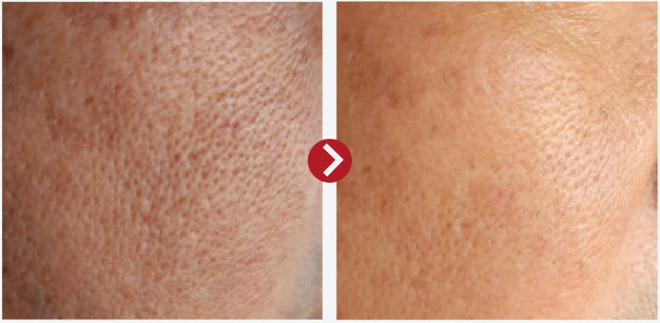 before and after pictures of glutathione users Magical Pill For Glowing Skin. Dose it really works! Advanced Pore Minimizing & Skin
